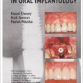 دانلود کتاب افزایش استخوان در ایمپلنتولوژی دهان<br>Bone Augmentation in Oral Implantology