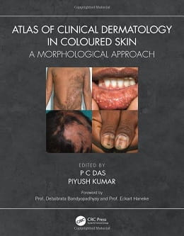 دانلود کتاب Atlas of Clinical Dermatology in Coloured Skin, 1ed