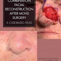 دانلود کتاب بازسازی صورت ترکیبی بعد از جراحی موس<br>Combination Facial Reconstruction after Mohs Surgery, 1ed