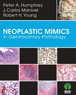 دانلود کتاب Neoplastic Mimics in Genitourinary Pathology, 1ed