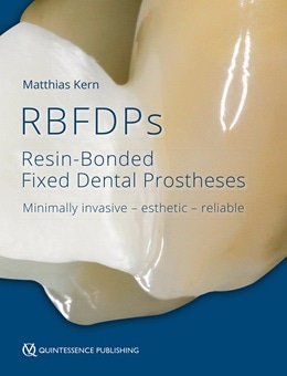 دانلود کتاب RBFDPs: Resin-Bonded Fixed Dental Prostheses