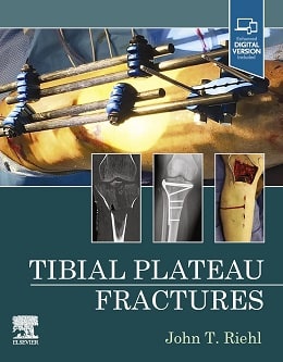 دانلود کتاب Tibial Plateau Fractures, 1ed